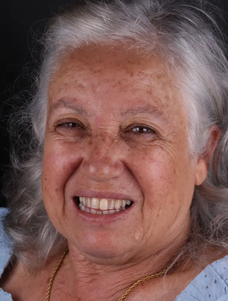 Antes: sorriso antes da reabilitação estética com lentes em resina