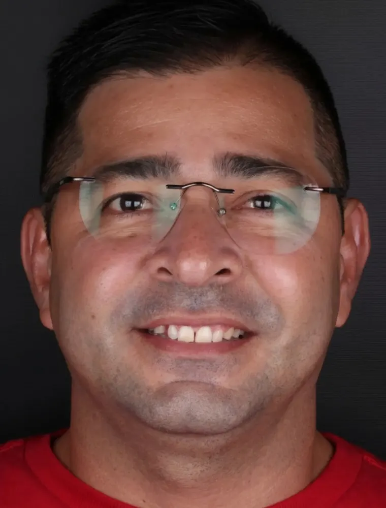 Antes: espaço entre os dentes da frente (diastema)
